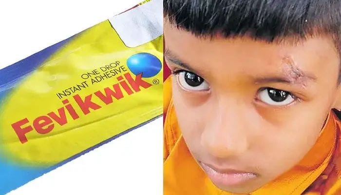 அடிப்பட்டவருக்கு (Fefiquick) பெஃவிக்குயிக் போட்டு ஒட்டிய - டாக்டரின் வித்தியாசமான வைத்தியம்