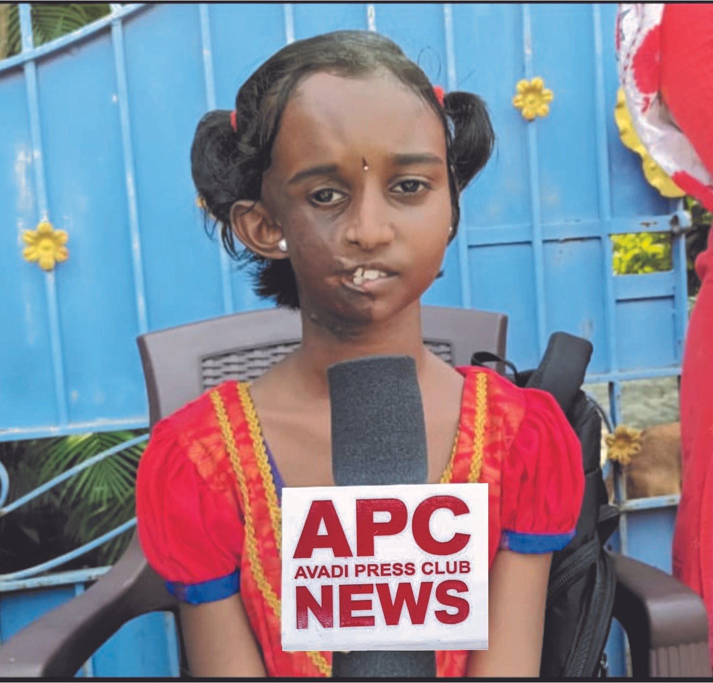 முகசிதைவு நோயால் பாதிக்கப்பட்ட சிறுமிக்கு ரூ.10 லட்சம் மதிப்பீட்டில் புதிய வீடு