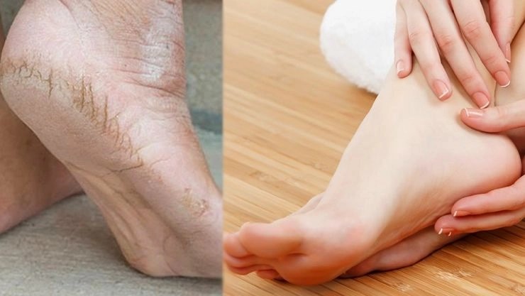 பாதங்களை மிருதுவாக வைப்பதற்கு நீங்கள் செய்ய வேண்டியவை!
