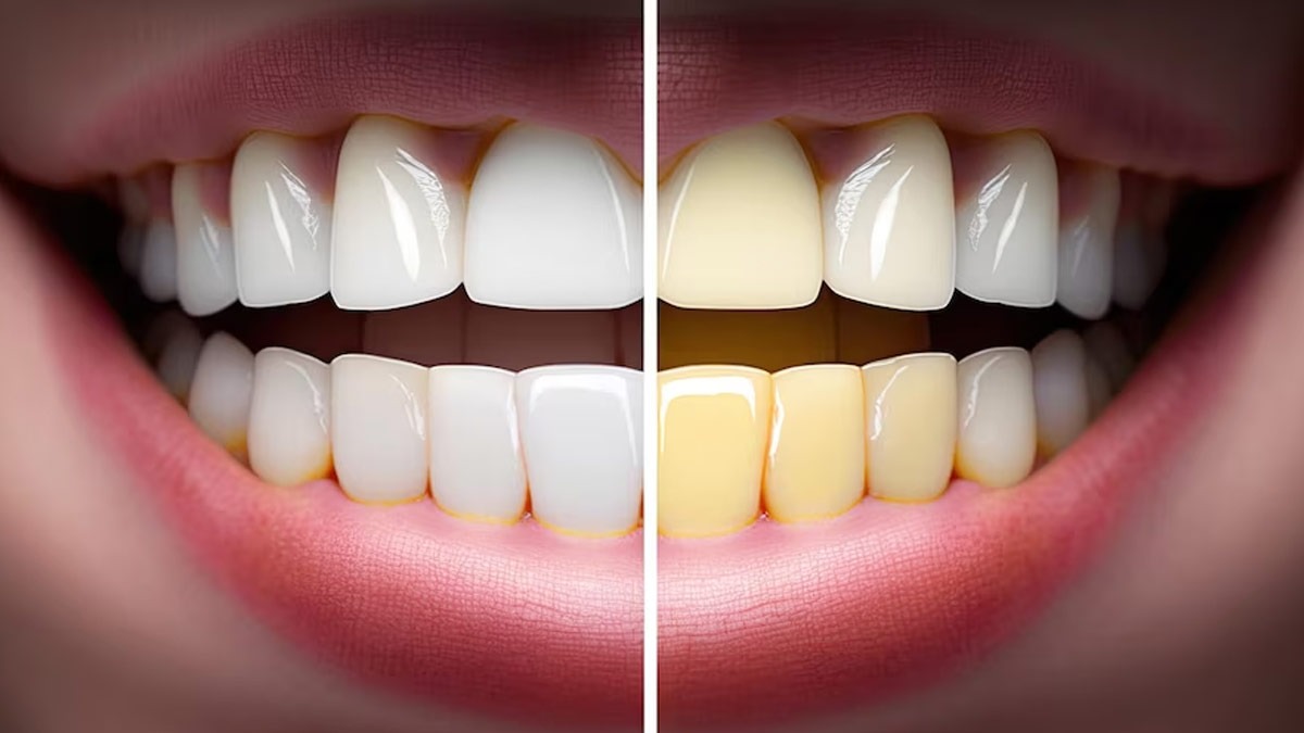 பற்களை பராமரிக்கும் வழிமுறைகள்!