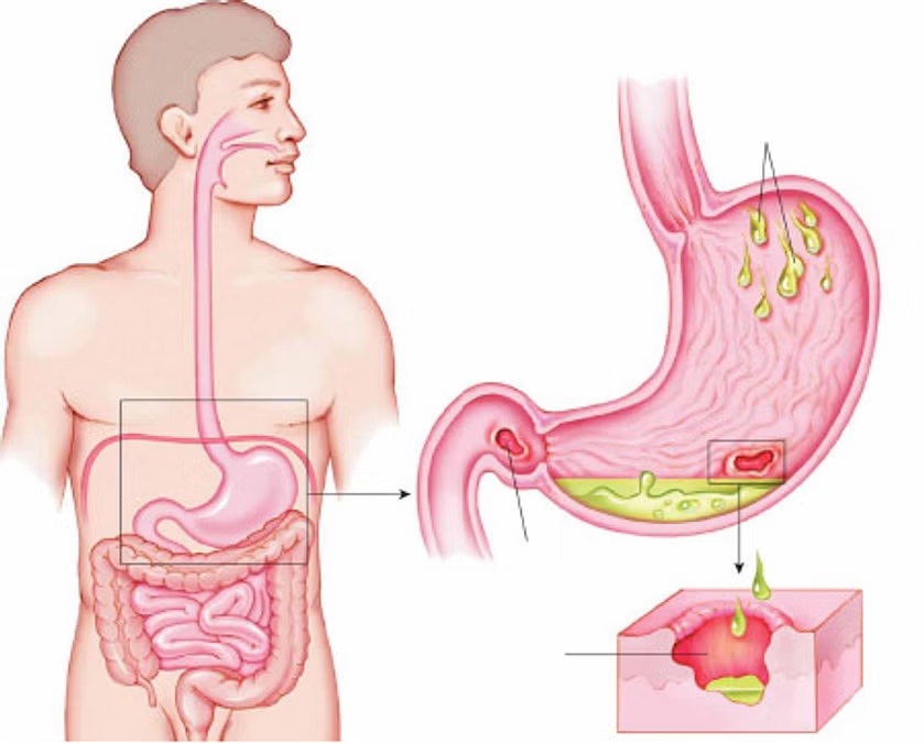 அல்சர் நோய் ஏற்பட காரணங்களும் அதனை தடுக்கும் வழிமுறைகளும்!