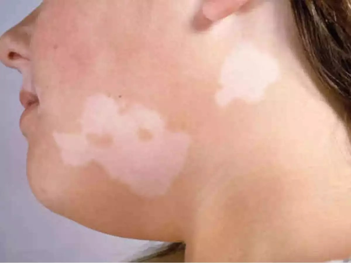 தேமல் மறைய சில டிப்ஸ்!