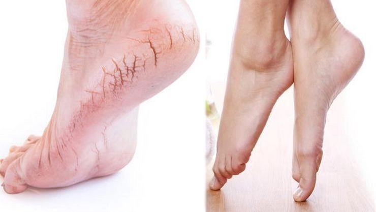 பாத வெடிப்பு மறைய இதை செய்து பாருங்கள்!