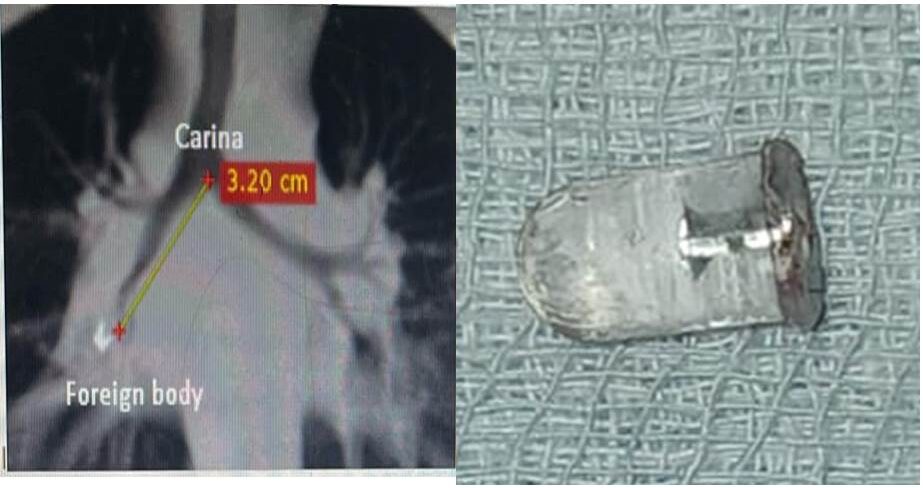 சிறுவனின் நுரையீரலில் சிக்கி கொண்டு இருந்த எல்.ஈ.டி பல்பை 