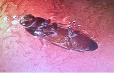 இளைஞர் குடலில் உயிருடன் இருந்த கரப்பான் பூச்சி - வயிற்றுக்குள் எப்படி சென்றது?