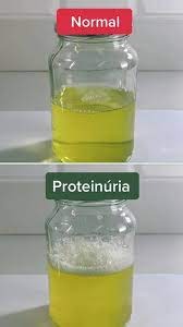 சிறுநீரில் அதிக அளவில் புரதம் வெளியேறுவது எதனால்? எவ்வாறு கண்டறிவது?