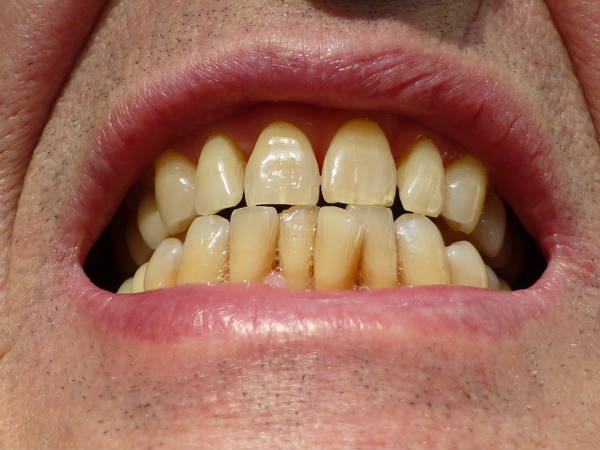 பற்களில் மஞ்சள் கறையா?.... இதோ உங்களுக்கான டிப்ஸ்!