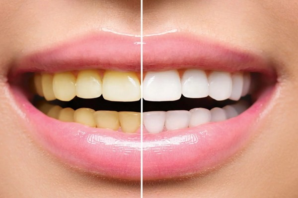 பற்களில் மஞ்சள் கறையா?.... இதோ உங்களுக்கான டிப்ஸ்!