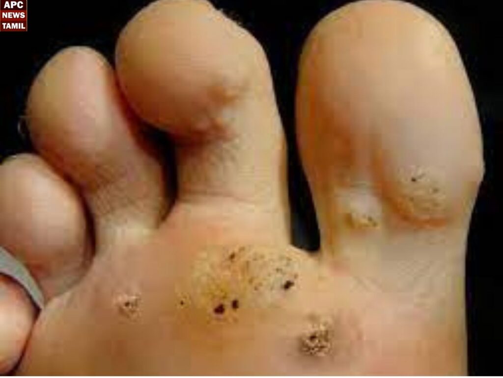 கால்ஆணியால் தொல்லையா? இனி கவலை வேண்டாம்…. 