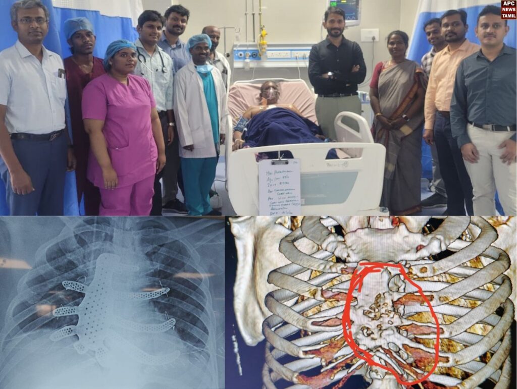 கூலி தொழிலாளிக்கு செயற்கை விலா எலும்பு பொறுத்தி அரசு மருத்துவர்கள் சாதனை